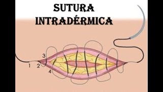 Sutura Intradérmica [upl. by Jenn]