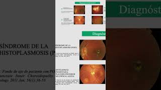 Síndrome de la Histoplasmosis Ocular [upl. by Vola]