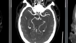 Large Artery Occlusion  Basilar [upl. by Atnahs629]