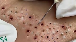 Big Cystic Acne Blackheads Extraction Blackheads amp Milia Whiteheads Removal Pimple Popping  8139 [upl. by Nauquf500]