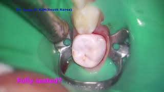 NuSmile ZR crown for lower 2nd primary molar [upl. by Acireh]