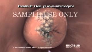 Progreso y estadificación del cáncer de cuello uterino [upl. by Nonac]