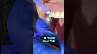 Teeth sensitivity after braces off  Braces removal  Toothtime Family Dentistry New Braunfels [upl. by Enyrb]