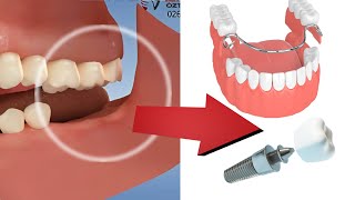 Çoklu diş kaybı sonrası oluşan problemler ve çözümler implant diş protezi  4K [upl. by Agatha]