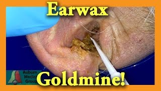 Earwax GOLDMINE  Auburn Medical Group [upl. by Jen]