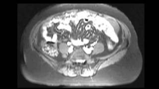 Primary peritoneal carcinomatosis [upl. by Isyak]