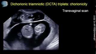 Chorionicity determination lambda sign on 3D scan [upl. by Court]