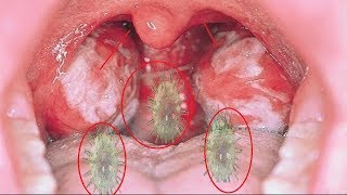 Home Remedies to Treat Mononucleosis  How to back Normal Throat [upl. by Silloh]