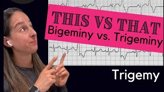 Bigeminy vs Trigeminy 🫀 [upl. by Cirre]