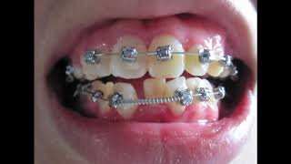 Braces  Before and After Time Lapse [upl. by Prisilla]