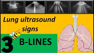 lung ultrasound signsBlines [upl. by Saraiya]