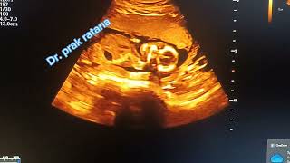 Pregnancy from first to last trimester by ultrasound scan subscribe for more video [upl. by Dwaine562]