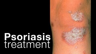 Psoriasis treatment options  related issues [upl. by Nirrep]