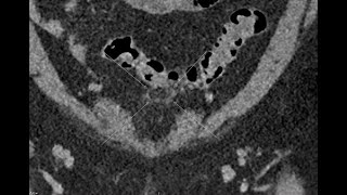 Epiploic appendagitis Clinical case  CT scan [upl. by Anil]