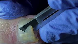 Ingrown Toenail Removal  Pedicure Treatment and Very Satisfying  Best Satisfying Nail Cutting [upl. by Notnek206]