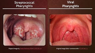 Streptococcal vs Viral Pharyngitis [upl. by Goldia]