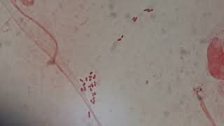 Gram negative bacteria in Gram staining of sputum [upl. by Ahseinar]