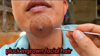 PLUCKING INGROWN FACIAL HAIR REMOVAL for Mr thxungdongcrovdsy asmr [upl. by Eedya]