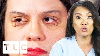 Dr Lee Removes Numerous Cysts From Womans Eyelids  Dr Pimple Popper [upl. by Guss]