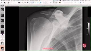 Upper Extremity Case Conference Shoulder Girdle [upl. by Naam675]