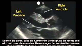 Anleitung Kardiologische Ultraschalluntersuchung – parasternal lange Achse – Teil 1 [upl. by Peednama]