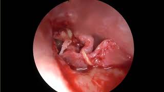 Endoscopic tympanoplasty with Cartilage ossiculoplasty [upl. by Itnava]