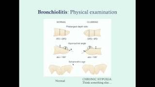 Bronchiolitis  CRASH Medical Review Series [upl. by Sakiv122]