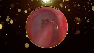 Ear Wax Removal [upl. by Oakie]