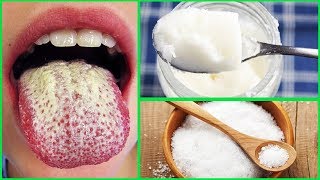 How To Get Rid of Oral Thrush with This 10 Simple Home Remedies [upl. by Bensky621]