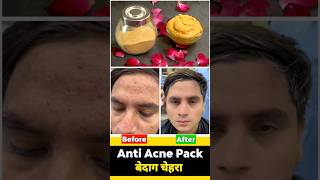 Anti Acne face mask  Best face pack for Acne prone skin  DIY for pimples amp acne  बेदाग चेहरा [upl. by Ahtan]