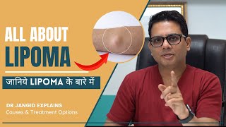 All About Lipoma  What are the causes and treatment options for Lipma  Lipoma Surgery in Delhi [upl. by Arva546]