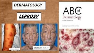 DERMATOLOGY  LEPROSY tuberculoid amp lepromatous derma lesion leprosy [upl. by Burford615]