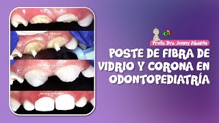 POSTE DE FIBRA DE VIDRIO Y CORONA EN ODONTOPEDIATRÍA [upl. by Iam]