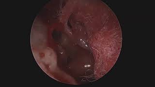 Timpanoplastia transcanal endoscópica [upl. by Winshell]