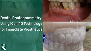 Full Arch Dental Photogrammetry Using ICam4D Technology for Immediate Prosthetics [upl. by Benson588]