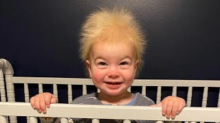 Baby Has Rare ‘Uncombable Hair Syndrome’ [upl. by Oliver]