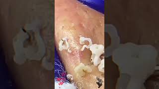 Skincare  Blackheads Removal 017 blackheads blackheads skincare [upl. by Brunell464]