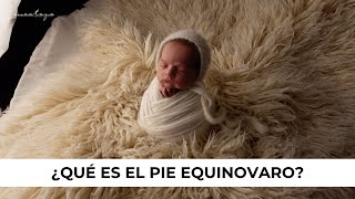 PIE EQUINOVARO ¿QUÉ ES ¿CÓMO lo TRATAN los MÉDICOS  Sesión Recién Nacido [upl. by Thorn]