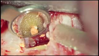 Endodontic MicroSurgery [upl. by Allemrac]