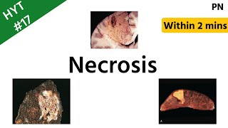 Necrosis  Types of Necrosis  Pathology  HYT 17  NEETPG  INICET [upl. by Neelhtak]