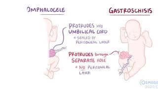 Omphalocele [upl. by Lux450]