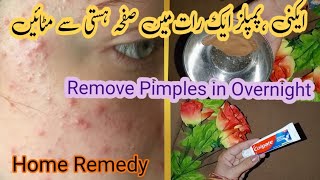 How To Remove Pimples Overnight  Acne Treatment  Home Remedy [upl. by Yenduhc484]