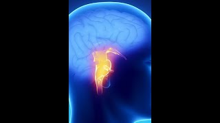 Brainstem syndromes stroke localization part 3 [upl. by Derina]