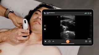 Ultrasound for Subclavian Central Line Placement [upl. by Houston]