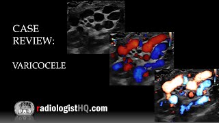 Ultrasound of Varicocele [upl. by Elboa660]