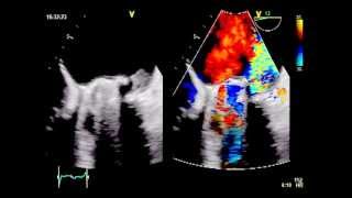 ROCKING MOTION  Major dehiscence of infected mitral valve prosthesis [upl. by Ajup]