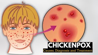 Chickenpox Causes Signs and Symptoms Diagnosis and Treatment [upl. by Harriott507]