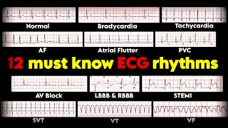 12 must know ECG rhythms  ECGEKG interpretation • Daily Cardiology [upl. by Tram]