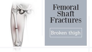 Femoral Shaft Fractures  broken thighbone [upl. by Kirstyn]