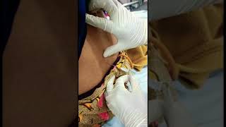 Cerebrospinal fluid CSF collection lumbar puncture procedure [upl. by Ahsienar]